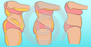 Woman body with designation of cellulite or fat photo